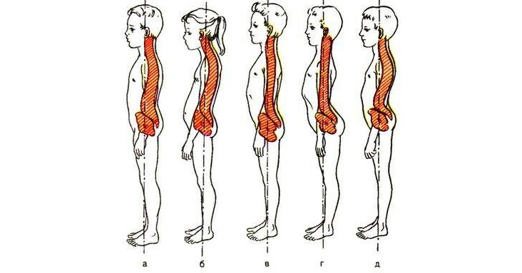 Следует различать сколиоз и боковые искривления позвоночника. Следует различать сколиоз и боковые искривления позвоночника.